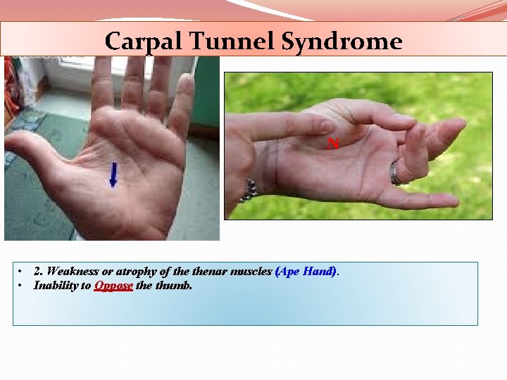 Carpal Tunnel Syndrome N • 2. Weakness or atrophy of thenar muscles (Ape Hand).