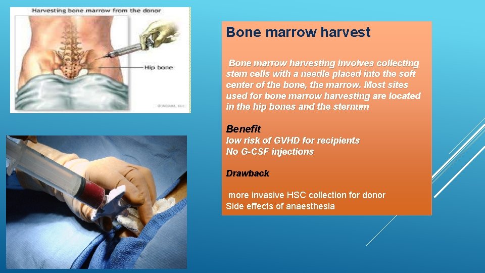 Bone marrow harvesting involves collecting stem cells with a needle placed into the soft