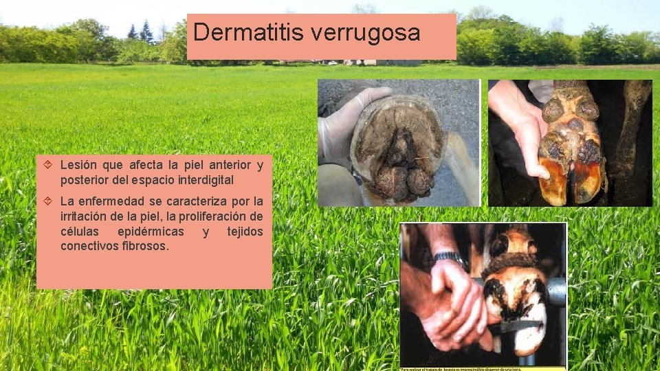 Dermatitis verrugosa Lesión que afecta la piel anterior y posterior del espacio interdigital La