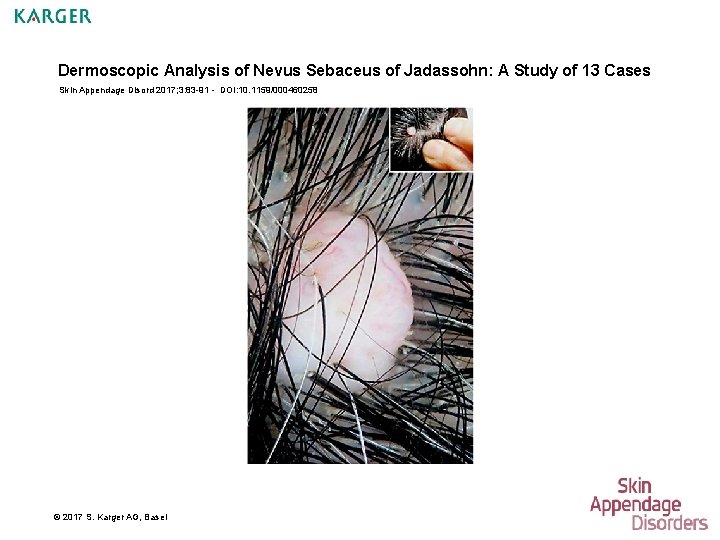 Dermoscopic Analysis of Nevus Sebaceus of Jadassohn: A Study of 13 Cases Skin Appendage
