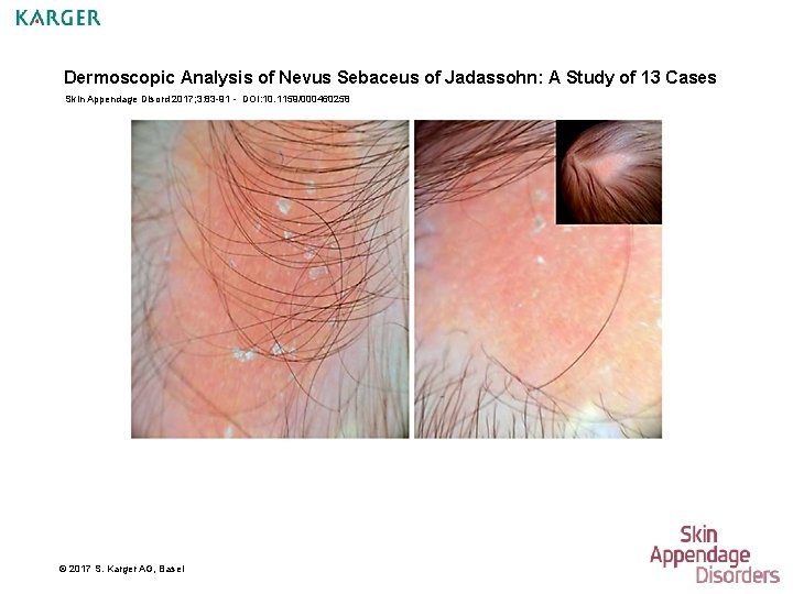Dermoscopic Analysis of Nevus Sebaceus of Jadassohn: A Study of 13 Cases Skin Appendage