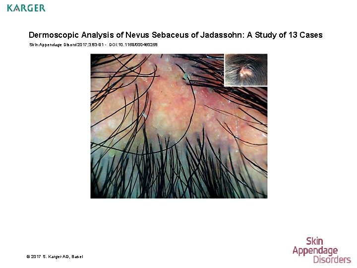 Dermoscopic Analysis of Nevus Sebaceus of Jadassohn: A Study of 13 Cases Skin Appendage