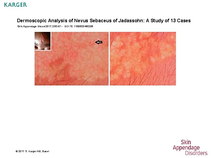 Dermoscopic Analysis of Nevus Sebaceus of Jadassohn: A Study of 13 Cases Skin Appendage