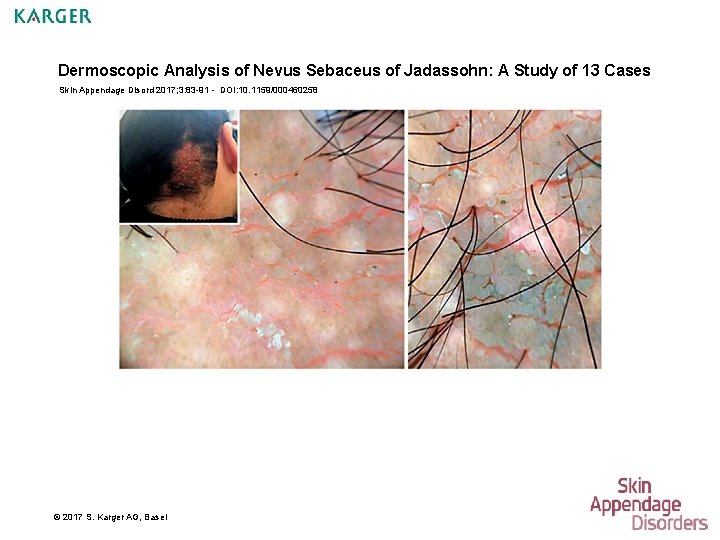 Dermoscopic Analysis of Nevus Sebaceus of Jadassohn: A Study of 13 Cases Skin Appendage