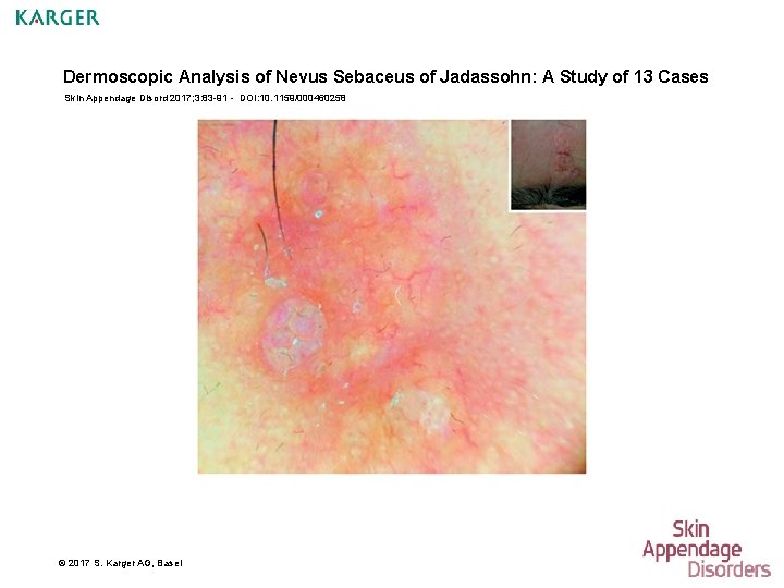 Dermoscopic Analysis of Nevus Sebaceus of Jadassohn: A Study of 13 Cases Skin Appendage
