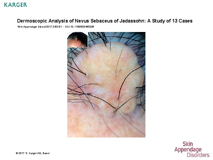 Dermoscopic Analysis of Nevus Sebaceus of Jadassohn: A Study of 13 Cases Skin Appendage