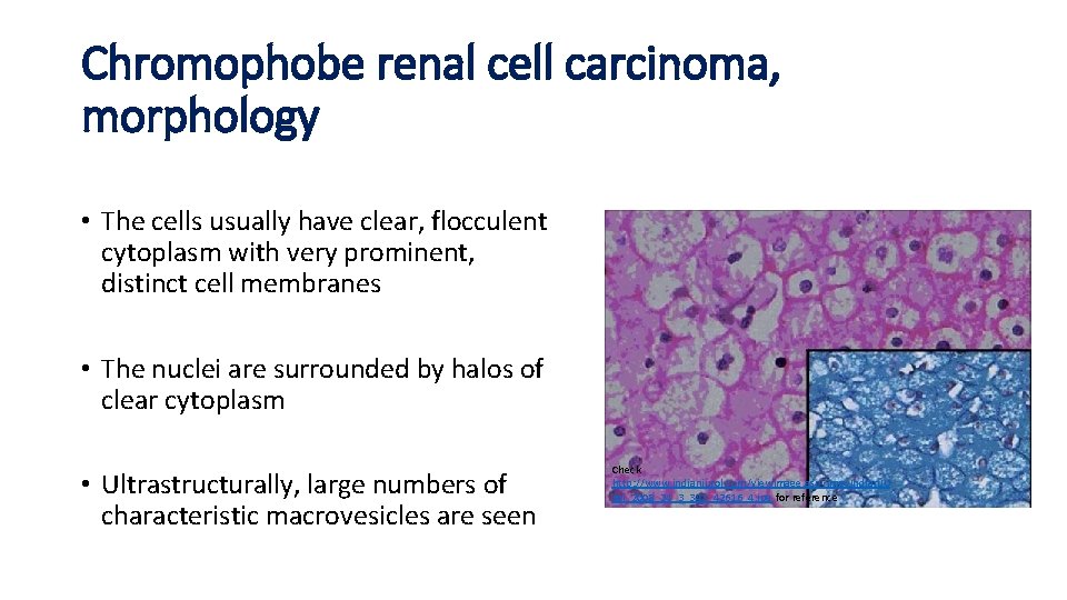 Chromophobe renal cell carcinoma, morphology • The cells usually have clear, flocculent cytoplasm with