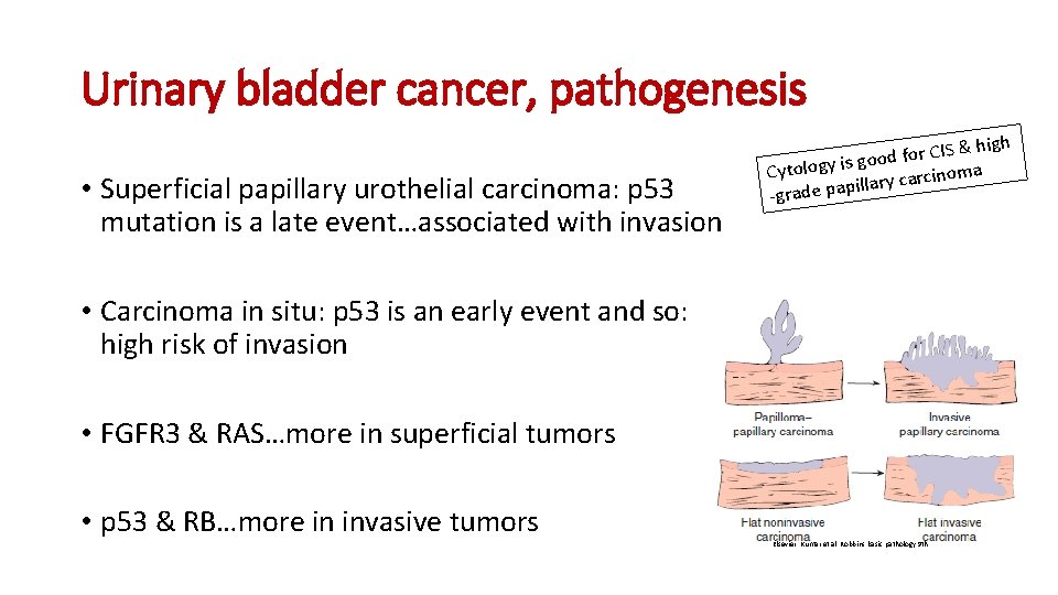 Urinary bladder cancer, pathogenesis • Superficial papillary urothelial carcinoma: p 53 mutation is a