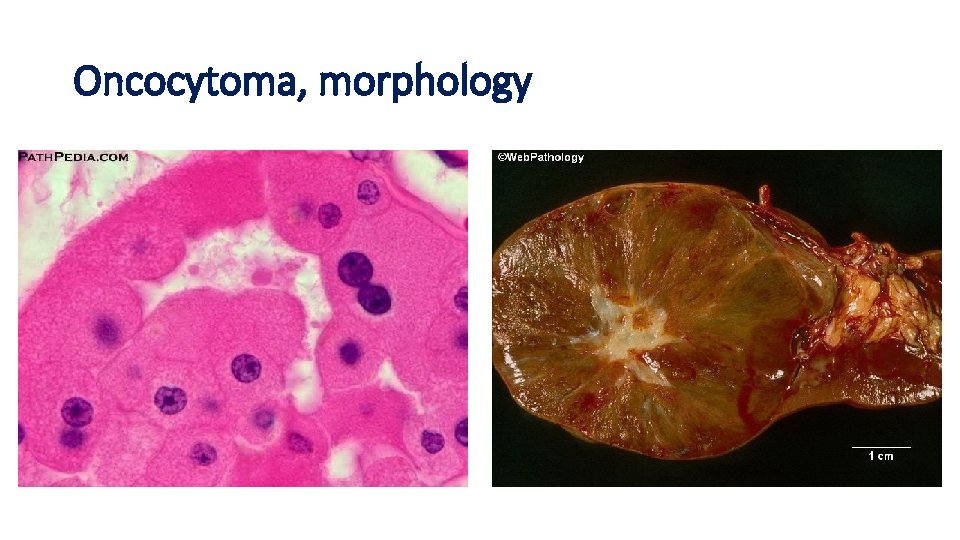 Oncocytoma, morphology 