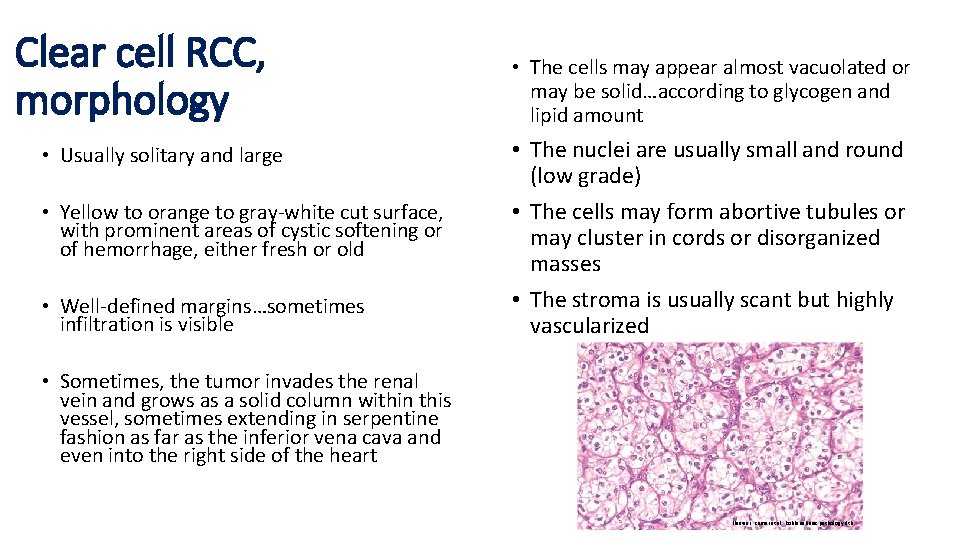 Clear cell RCC, morphology • Usually solitary and large • Yellow to orange to