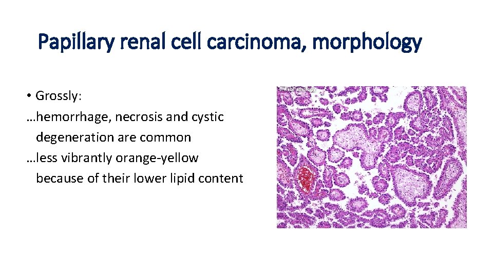 Papillary renal cell carcinoma, morphology • Grossly: …hemorrhage, necrosis and cystic degeneration are common