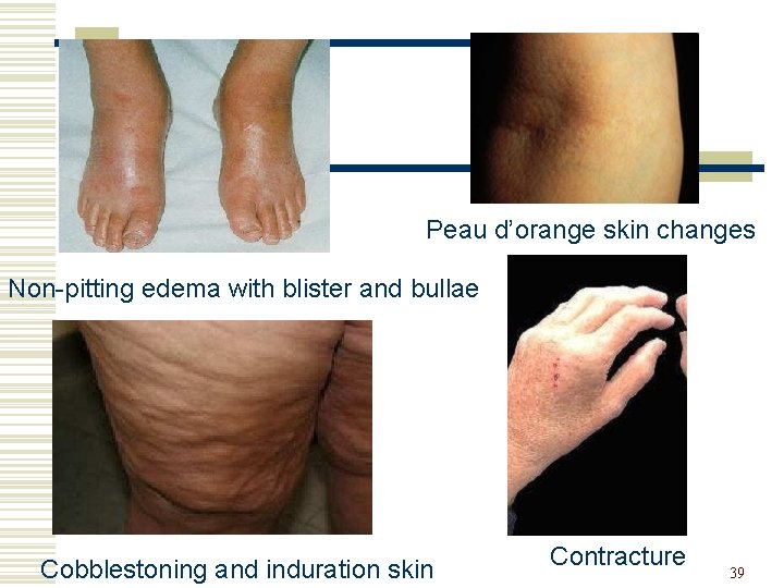 Peau d’orange skin changes Non-pitting edema with blister and bullae Cobblestoning and induration skin