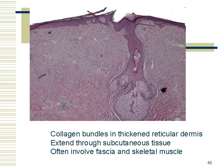 Collagen bundles in thickened reticular dermis Extend through subcutaneous tissue Often involve fascia and