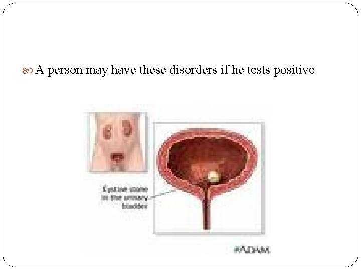 A person may have these disorders if he tests positive   A person may have these disorders if he tests positive