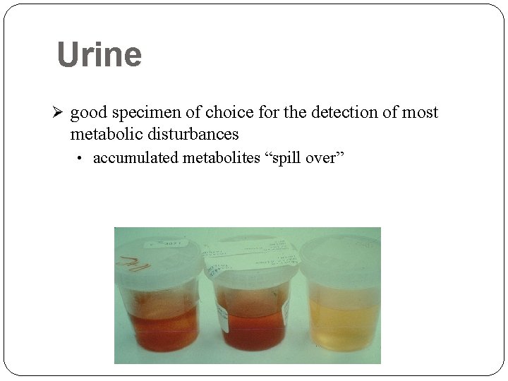 Urine Ø good specimen of choice for the detection of most metabolic disturbances • Urine Ø good specimen of choice for the detection of most metabolic disturbances •