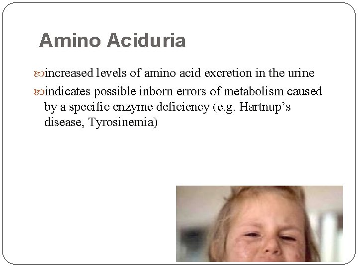 Amino Aciduria increased levels of amino acid excretion in the urine indicates possible inborn Amino Aciduria increased levels of amino acid excretion in the urine indicates possible inborn