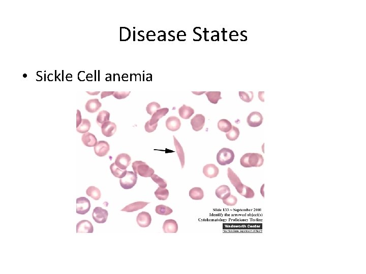Disease States • Sickle Cell anemia 
