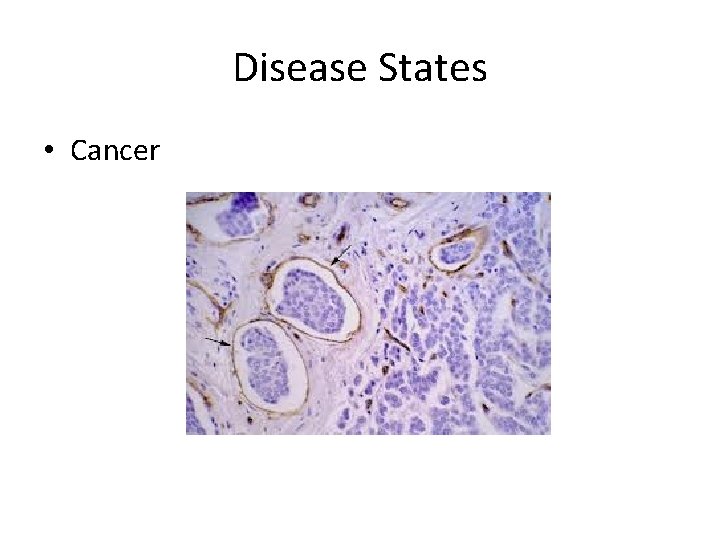 Disease States • Cancer 