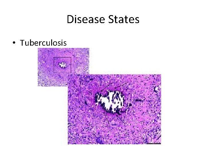 Disease States • Tuberculosis 