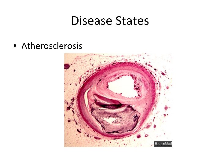 Disease States • Atherosclerosis 
