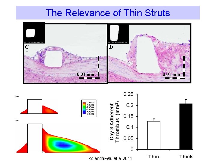 The Relevance of Thin Struts C D 0. 01 mm Kolandaivelu et al 2011