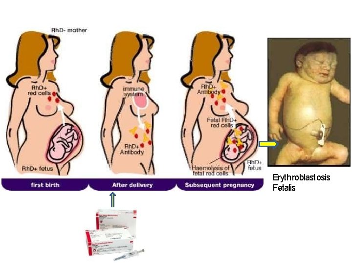 Erythroblastosis Fetalis Erythroblastosis Fetalis