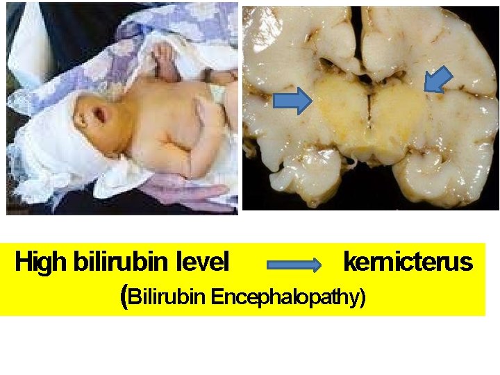 High bilirubin level kernicterus (Bilirubin Encephalopathy) High bilirubin level kernicterus (Bilirubin Encephalopathy)