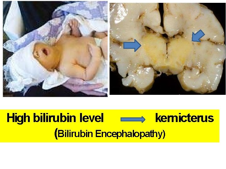 High bilirubin level kernicterus (Bilirubin Encephalopathy) 