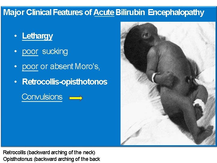Major Clinical Features of Acute Bilirubin Encephalopathy • Lethargy • poor sucking • poor Major Clinical Features of Acute Bilirubin Encephalopathy • Lethargy • poor sucking • poor