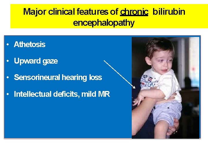 Major clinical features of chronic bilirubin encephalopathy • Athetosis • Upward gaze • Sensorineural Major clinical features of chronic bilirubin encephalopathy • Athetosis • Upward gaze • Sensorineural
