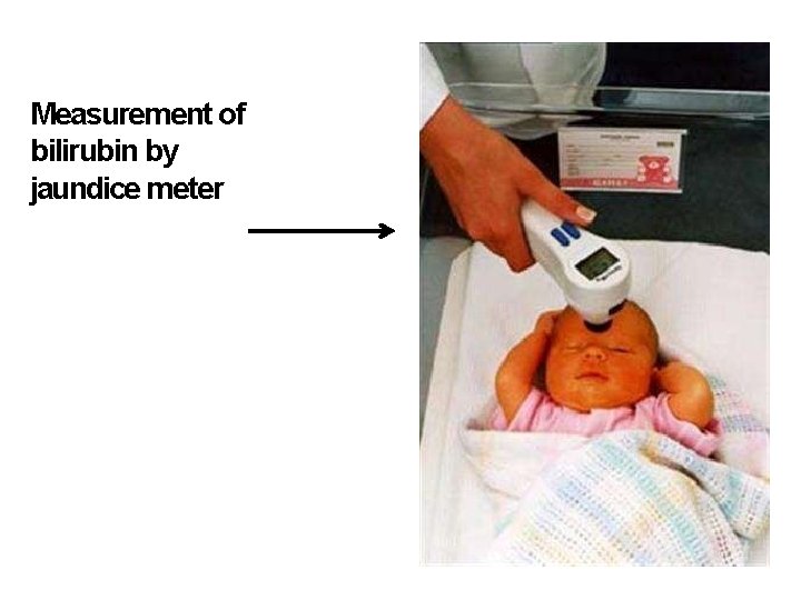 Measurement of bilirubin by jaundice meter 