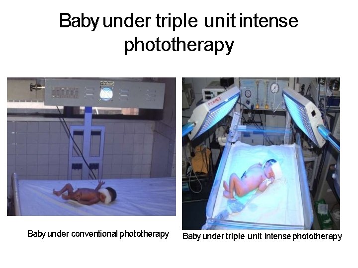 Baby under triple unit intense phototherapy Baby under conventional phototherapy Baby under triple unit