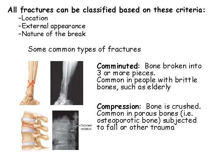 All fractures can be classified based on these criteria: –Location –External appearance –Nature of