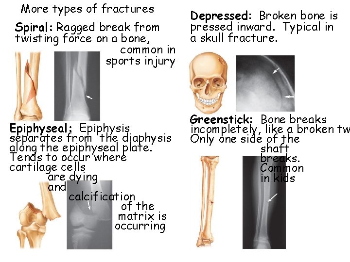 More types of fractures Spiral: Ragged break from twisting force on a bone, common