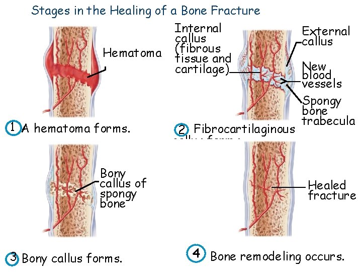 Stages in the Healing of a Bone Fracture Internal callus Hematoma (fibrous tissue and