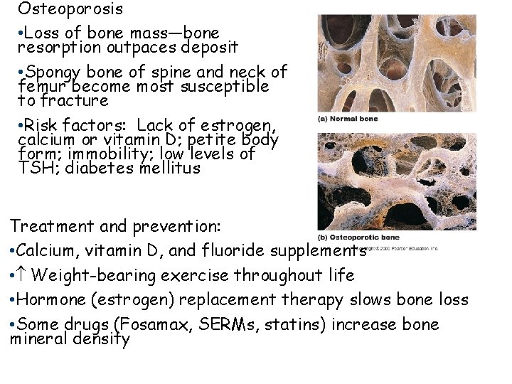 Osteoporosis • Loss of bone mass—bone resorption outpaces deposit • Spongy bone of spine