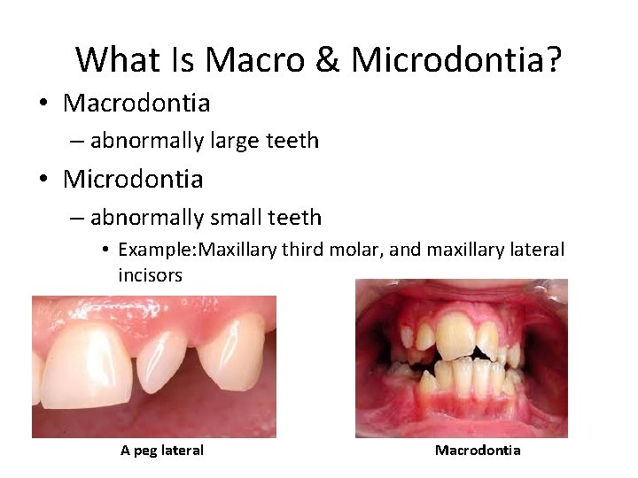 What Is Macro & Microdontia? • Macrodontia – abnormally large teeth • Microdontia –