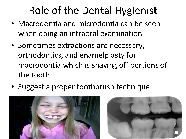 Role of the Dental Hygienist • Macrodontia and microdontia can be seen when doing