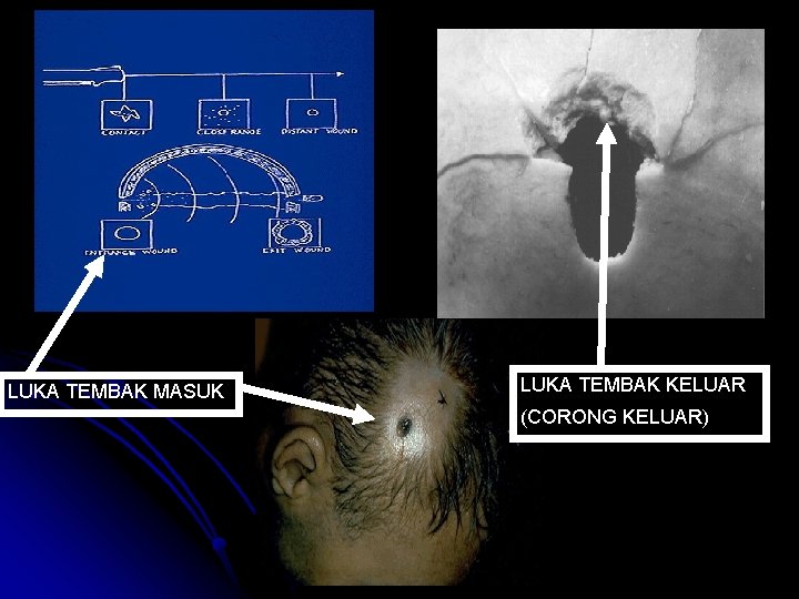 LUKA TEMBAK MASUK LUKA TEMBAK KELUAR (CORONG KELUAR) 