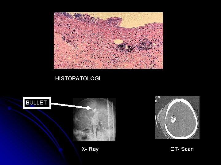 HISTOPATOLOGI BULLET X- Ray CT- Scan 