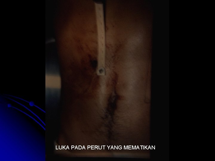 LUKA PADA PERUT YANG MEMATIKAN 