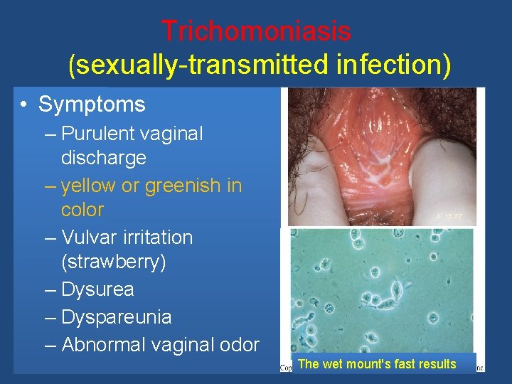 Trichomoniasis (sexually-transmitted infection) • Symptoms – Purulent vaginal discharge – yellow or greenish in