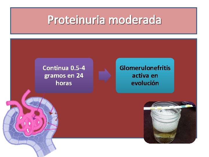 Proteinuria moderada Continua 0. 5 -4 gramos en 24 horas Glomerulonefritis activa en evolución