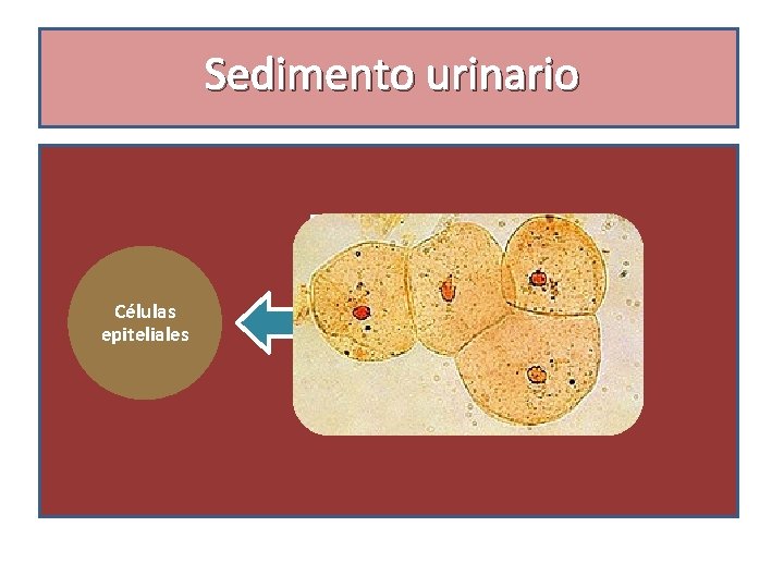 Sedimento urinario Células epiteliales ü Nefrosis tubular aguda ü Glomerulonefritis aguda ü Nefroesclerosis maligna