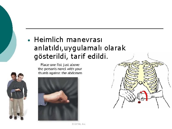  • Heimlich manevrası anlatıldı, uygulamalı olarak gösterildi, tarif edildi. 