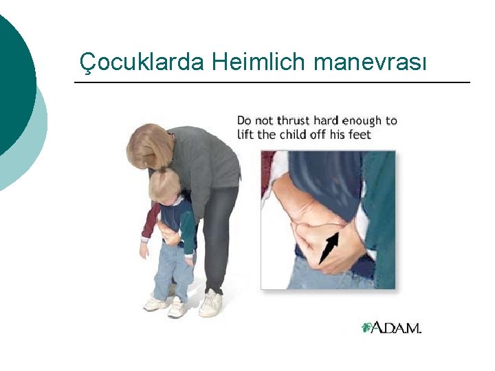 Çocuklarda Heimlich manevrası 