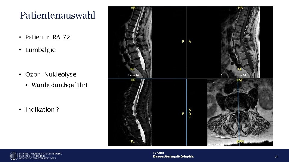 Patientenauswahl • Patientin RA 72 J • Lumbalgie • Ozon-Nukleolyse • Wurde durchgeführt •