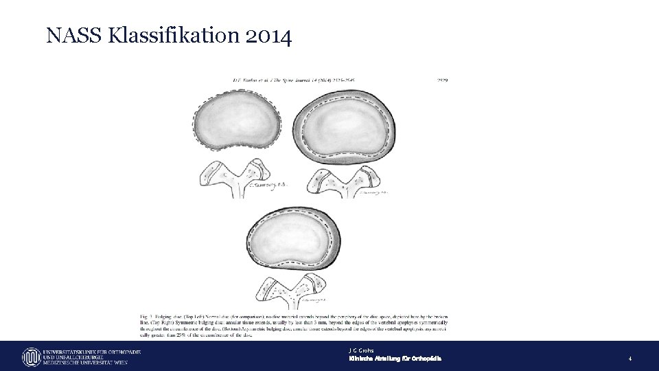 NASS Klassifikation 2014 J G Grohs Klinische Abteilung für Orthopädie 4 