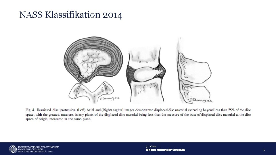 NASS Klassifikation 2014 J G Grohs Klinische Abteilung für Orthopädie 5 