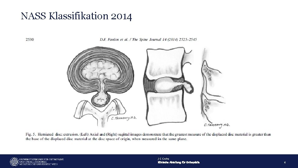 NASS Klassifikation 2014 J G Grohs Klinische Abteilung für Orthopädie 6 